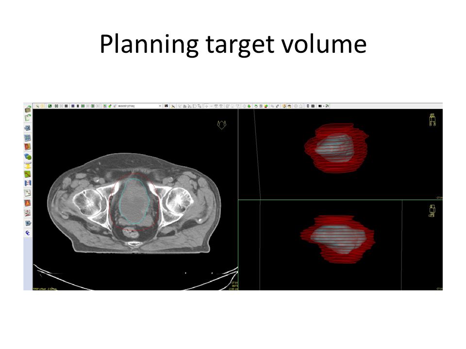 Planning target volume