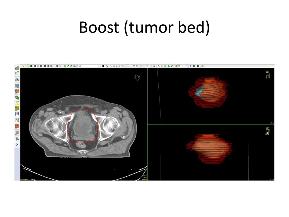 Boost (tumor bed)