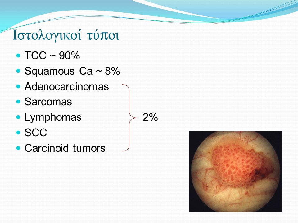 Ιστολογικοί τύ π οι TCC ~ 90% Squamous Ca ~ 8% Adenocarcinomas Sarcomas Lymphomas 2% SCC Carcinoid tumors