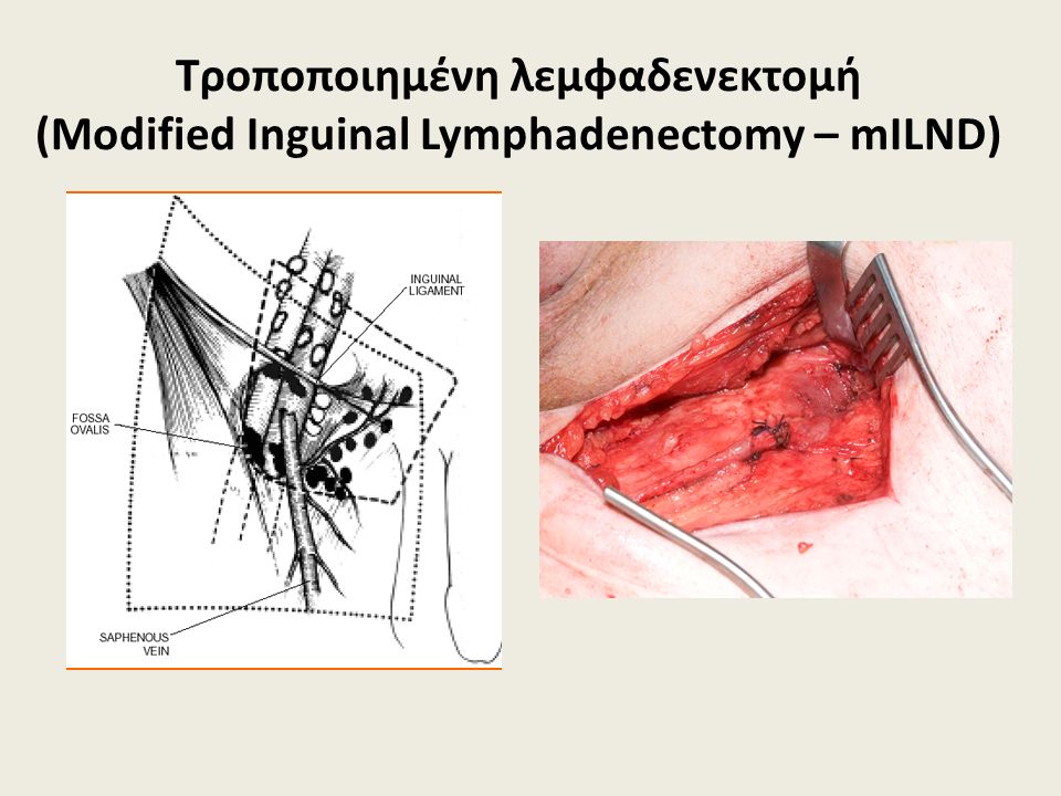 Τροποποιημένη λεμφαδενεκτομή (Modified Inguinal Lymphadenectomy – mILND)