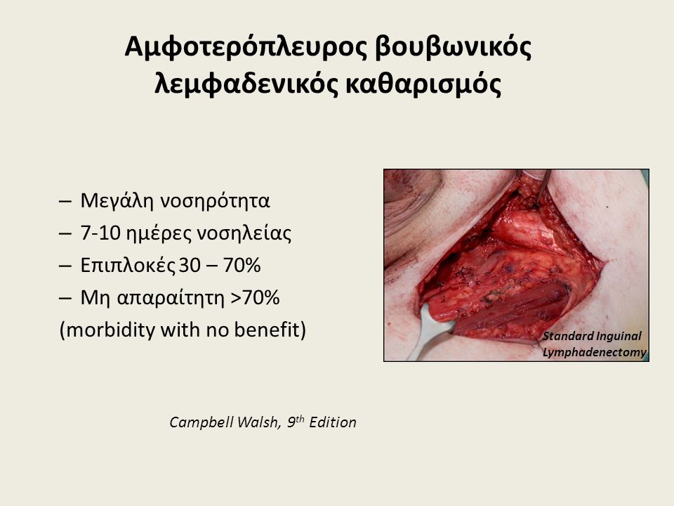 Aμφοτερόπλευρος βουβωνικός λεμφαδενικός καθαρισμός – Μεγάλη νοσηρότητα – 7-10 ημέρες νοσηλείας – Επιπλοκές 30 – 70% – Μη απαραίτητη >70% (morbidity with no benefit) Campbell Walsh, 9 th Edition Standard Inguinal Lymphadenectomy