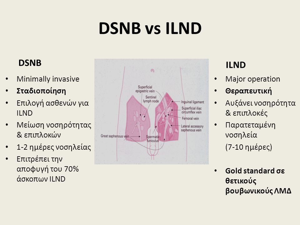 DSNB vs ILND DSNB Minimally invasive Σταδιοποίηση Επιλογή ασθενών για ILND Μείωση νοσηρότητας & επιπλοκών 1-2 ημέρες νοσηλείας Επιτρέπει την αποφυγή του 70% άσκοπων ILND ILND Major operation Θεραπευτική Αυξάνει νοσηρότητα & επιπλοκές Παρατεταμένη νοσηλεία (7-10 ημέρες) Gold standard σε θετικούς βουβωνικούς ΛΜΔ