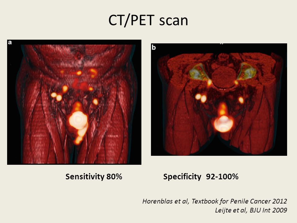 CT/PET scan Sensitivity 80% Specificity % Horenblas et al, Textbook for Penile Cancer 2012 Leijte et al, BJU Int 2009