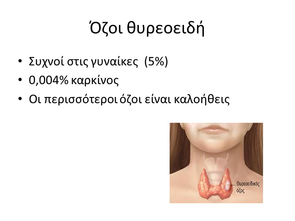 Όζοι θυρεοειδή Συχνοί στις γυναίκες (5%) 0,004% καρκίνος Οι περισσότεροι όζοι είναι καλοήθεις