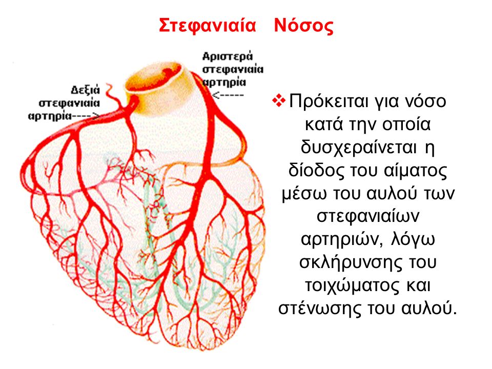Στεφανιαία Νόσος  Πρόκειται για νόσο κατά την οποία δυσχεραίνεται η δίοδος του αίματος μέσω του αυλού των στεφανιαίων αρτηριών, λόγω σκλήρυνσης του τοιχώματος και στένωσης του αυλού.