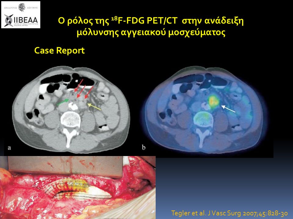 Ο ρόλος της 18 F-FDG PET/CT στην ανάδειξη μόλυνσης αγγειακού μοσχεύματος Case Report Tegler et al.