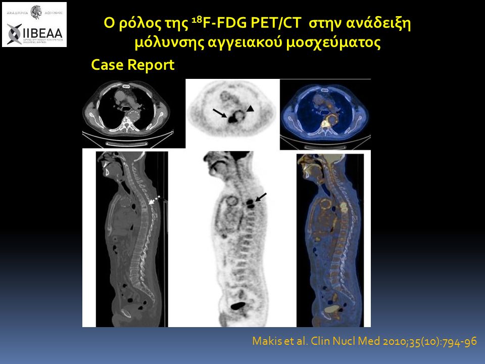 Ο ρόλος της 18 F-FDG PET/CT στην ανάδειξη μόλυνσης αγγειακού μοσχεύματος Case Report Makis et al.
