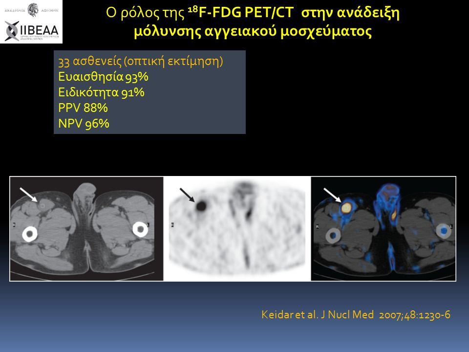 Ο ρόλος της 18 F-FDG PET/CT στην ανάδειξη μόλυνσης αγγειακού μοσχεύματος 33 ασθενείς (οπτική εκτίμηση) Ευαισθησία 93% Ειδικότητα 91% PPV 88% NPV 96% Keidar et al.