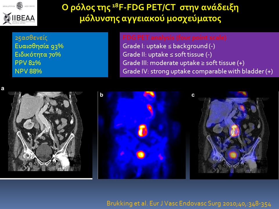 Ο ρόλος της 18 F-FDG PET/CT στην ανάδειξη μόλυνσης αγγειακού μοσχεύματος 25ασθενείς Ευαισθησία 93% Ειδικότητα 70% PPV 82% NPV 88% FDG PET analysis (four point scale) Grade Ι: uptake ≤ background (-) Grade II: uptake ≤ soft tissue (-) Grade III: moderate uptake ≥ soft tissue (+) Grade IV: strong uptake comparable with bladder (+) Brukking et al.