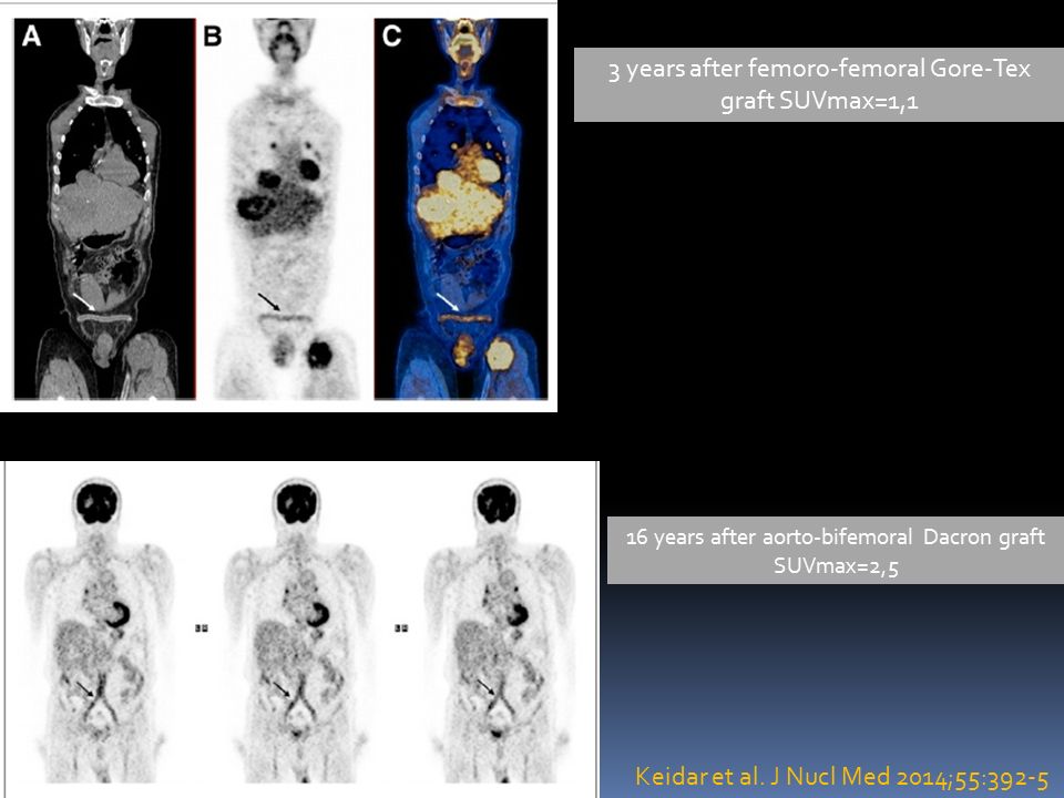 3 years after femoro-femoral Gore-Tex graft SUVmax=1,1 16 years after aorto-bifemoral Dacron graft SUVmax=2,5 Keidar et al.