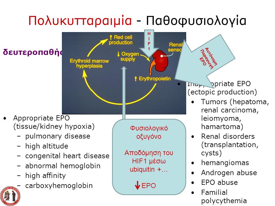 Πολυκυτταραιμία - Παθοφυσιολογία δευτεροπαθής Appropriate EPO (tissue/kidney hypoxia) –pulmonary disease –high altitude –congenital heart disease –abnormal hemoglobin –high affinity –carboxyhemoglobin Inappropriate EPO (ectopic production) Tumors (hepatoma, renal carcinoma, leiomyoma, hamartoma) Renal disorders (transplantation, cysts) hemangiomas Androgen abuse EPO abuse Familial polycythemia HIF1HIF1 Φυσιολογικό οξυγόνο Αποδόμηση του HIF1 μέσω ubiquitin +… ΕΡΟ Αυτόνομη Παραγωγή ΕΡΟ