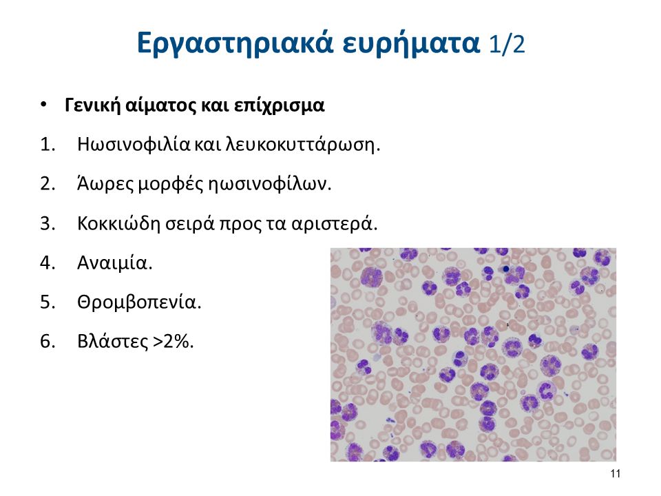 Εργαστηριακά ευρήματα 1/2 Γενική αίματος και επίχρισμα 1.Ηωσινοφιλία και λευκοκυττάρωση.