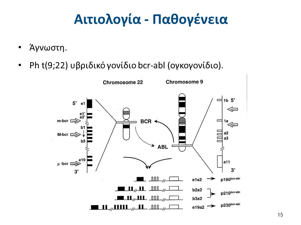 Αιτιολογία - Παθογένεια Άγνωστη. Ph t(9;22) υβριδικό γονίδιο bcr-abl (ογκογονίδιο). 15