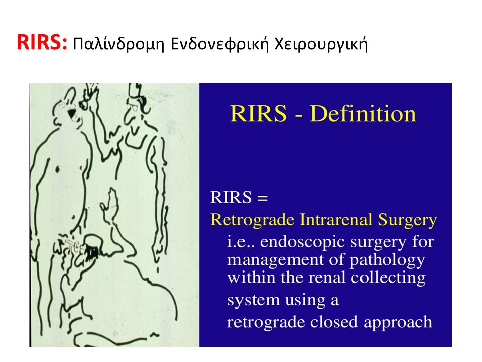 RIRS: Παλίνδρομη Ενδονεφρική Χειρουργική