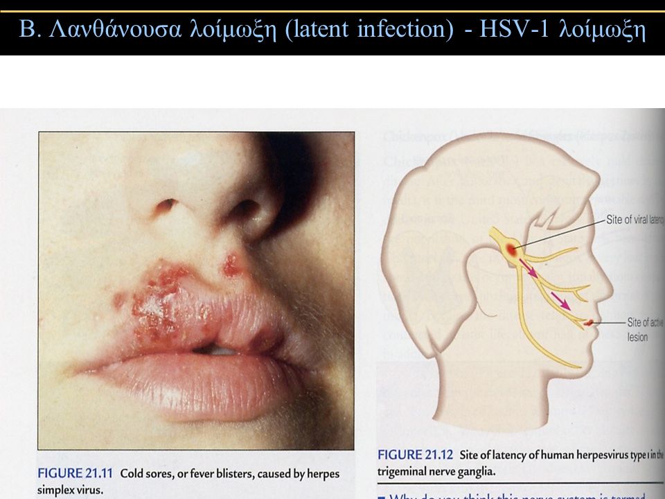 Β. Λανθάνουσα λοίμωξη (latent infection) - HSV-1 λοίμωξη