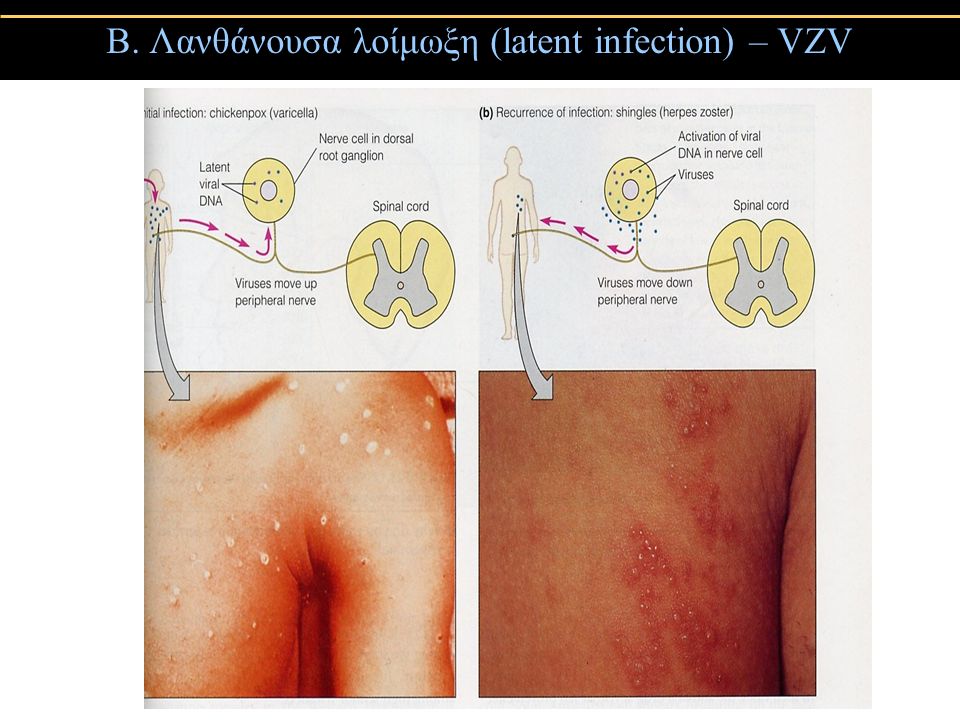 Β. Λανθάνουσα λοίμωξη (latent infection) – VZV