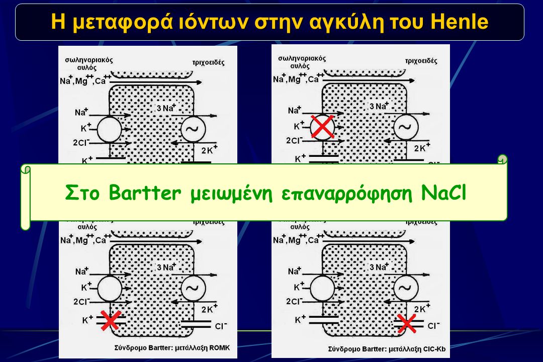 Η μεταφορά ιόντων στην αγκύλη του Henle Στο Bartter μειωμένη επαναρρόφηση NaCl